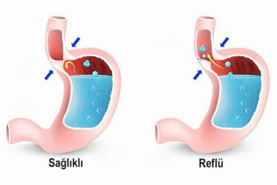 Sahurdan sonra reflü atakları tetiklenir mi?